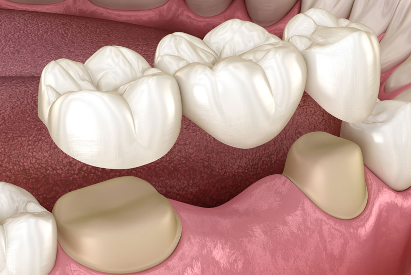 a model showing a dental bridge being placed