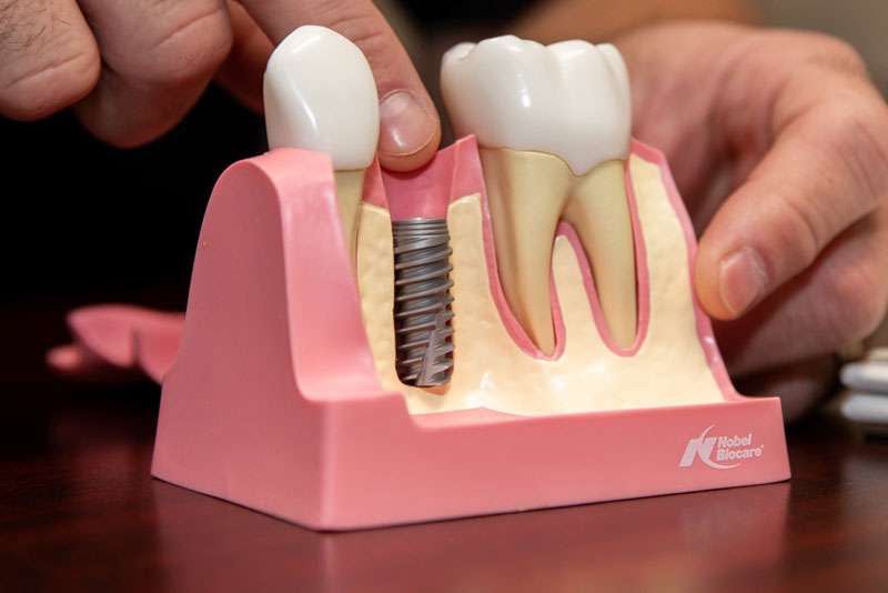 a model of a placed titanium post in the jaw