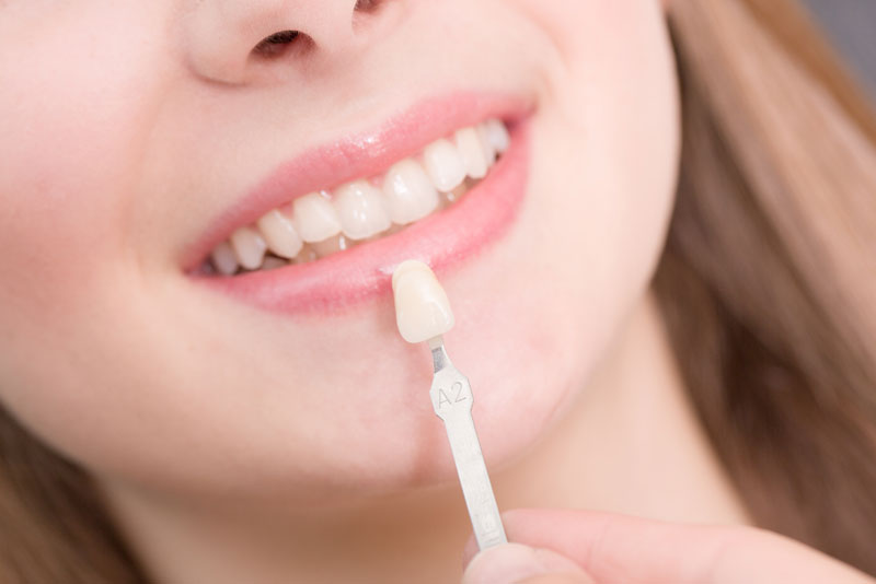 Dental Veneers Patient