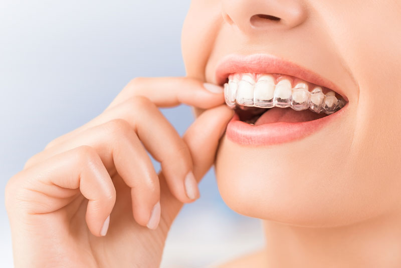 Dental Patient Wearing Invisalign Retainers