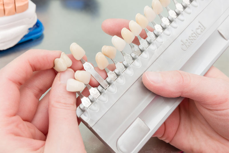 Dentist Holding A Row Of Dental Veneer Models