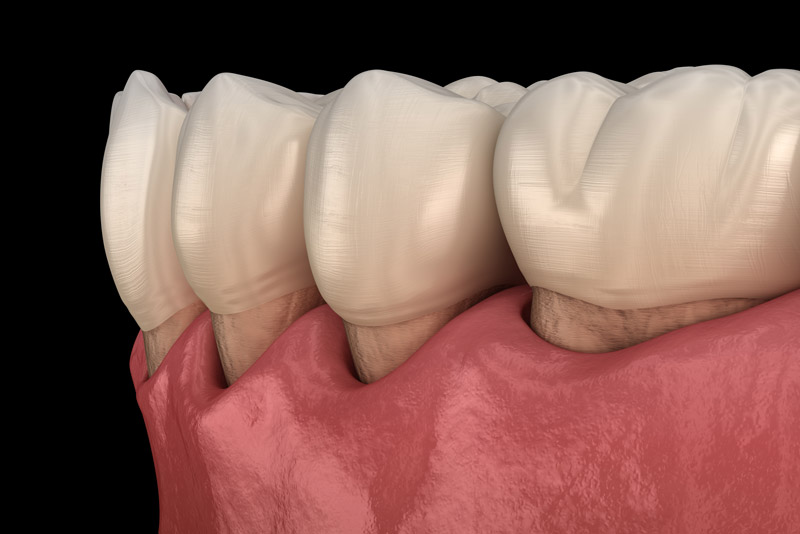 Gum Recession Close Up Graphic