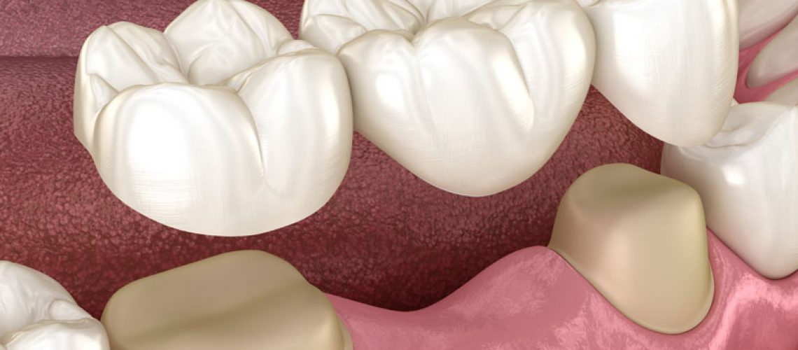 a model showing a dental bridge being placed