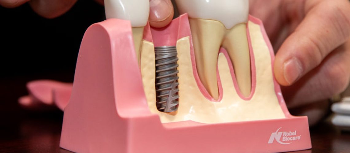 a model of a placed titanium post in the jaw
