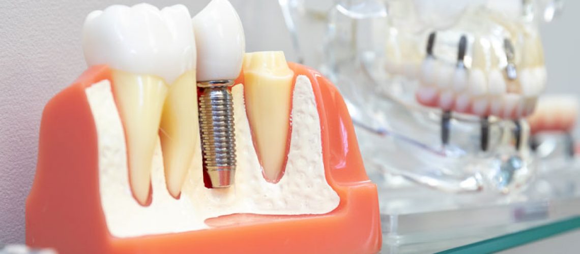 a model of a placed dental implant